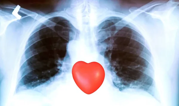 Рентген Легких Пациента Явными Следами Воспалительного Процесса Красным Знаком Сердца — стоковое фото