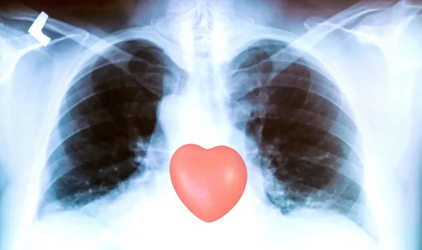 Ray Patient Lungs Pronounced Traces Inflammatory Process Red Heart Sign — Stock Photo, Image