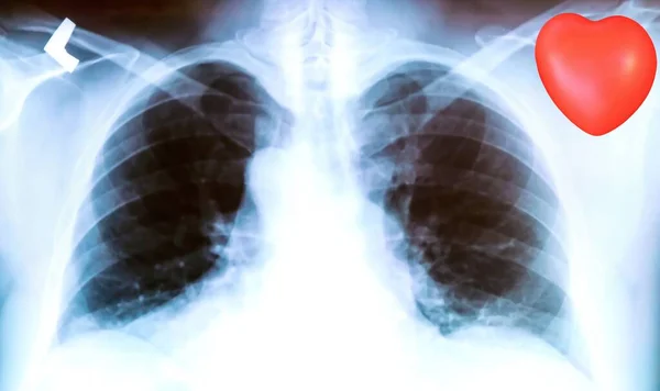 Radiografía Los Pulmones Paciente Con Trazas Pronunciadas Del Proceso Inflamatorio — Foto de Stock