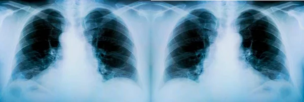 Conjunto Radiografías Los Pulmones Paciente Con Trazas Pronunciadas Del Proceso — Foto de Stock