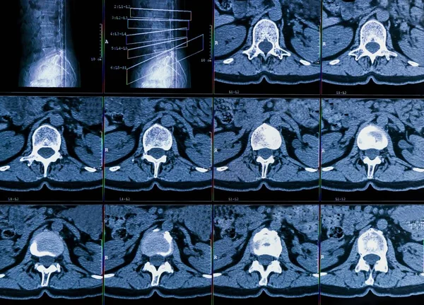 慢性背痛患者脊柱计算机断层扫描或Ct成像结果显示 脊柱退变 腰椎间盘突出和神经根压 — 图库照片