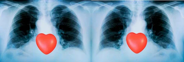 炎症プロセスと赤いハートサインの顕著な痕跡を持つ患者の肺のX線のセット — ストック写真