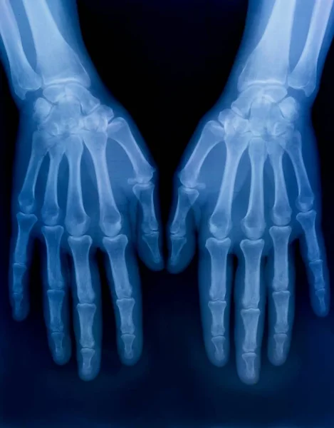 Mindkét Emberi Kéz Csontjainak Röntgenlemeze — Stock Fotó