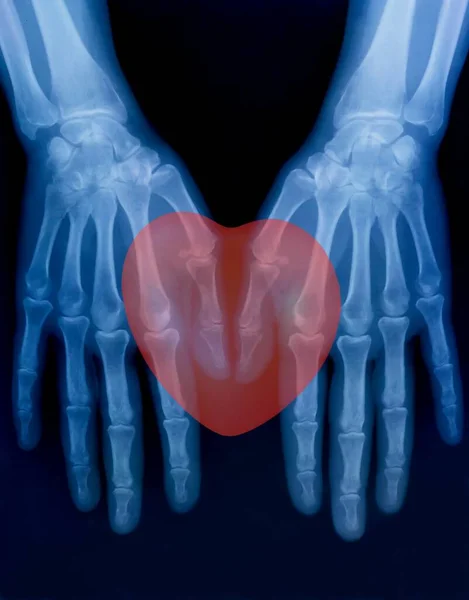 Ray Plate Bones Both Human Hands Red Heart Sign — Stock Photo, Image