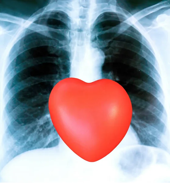 X-ray of a patient\'s lungs with pronounced traces of the inflammatory process and red heart sign .