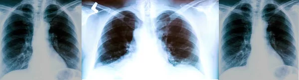 Conjunto Radiografías Los Pulmones Paciente Con Trazas Pronunciadas Del Proceso —  Fotos de Stock
