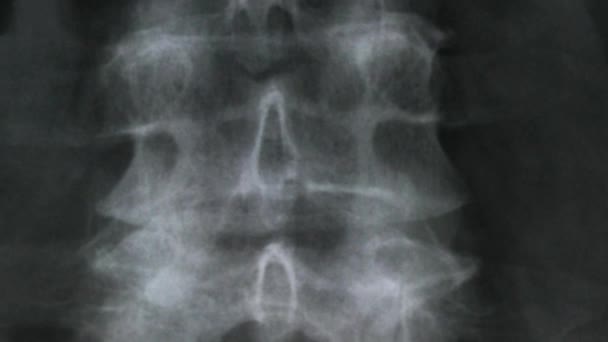 Radiografía Los Huesos Columna Vertebral Humana Pelvis — Vídeo de stock