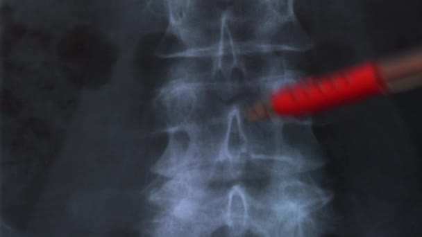 Arzt Untersucht Röntgenbild Der Knochen Der Menschlichen Wirbelsäule — Stockvideo
