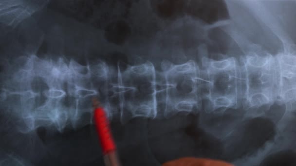 Doctor studying X-ray of the bones of the human vertebral column , 4K — Stock Footage Doctor Studying Ray Bones Human Vertebral Column Royalty Free Stock Footage