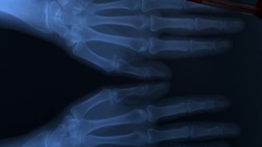 Doktor, iki insan elinin de kemiklerinin röntgen tablosunu inceliyor.