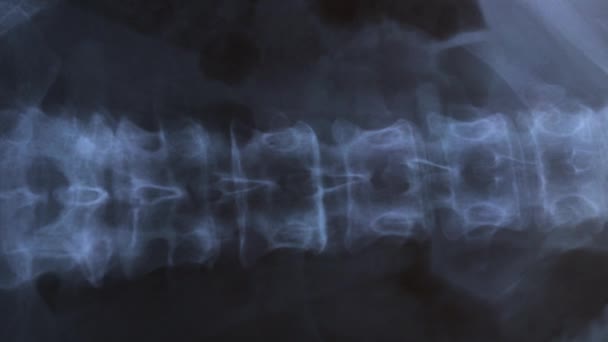 Dokter Mempelajari Ray Dari Tulang Manusia Vertebral Kolom — Stok Video