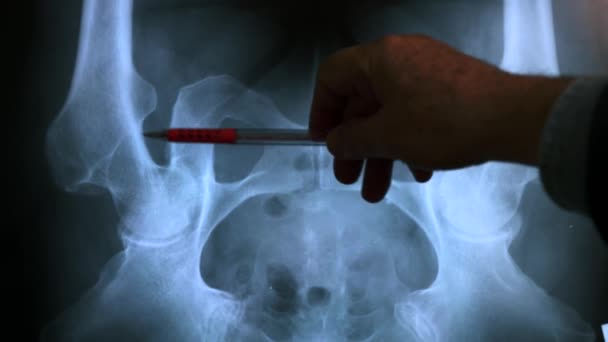 Γιατρός Που Μελετά Ακτινογραφία Πυελικών Οστών — Αρχείο Βίντεο