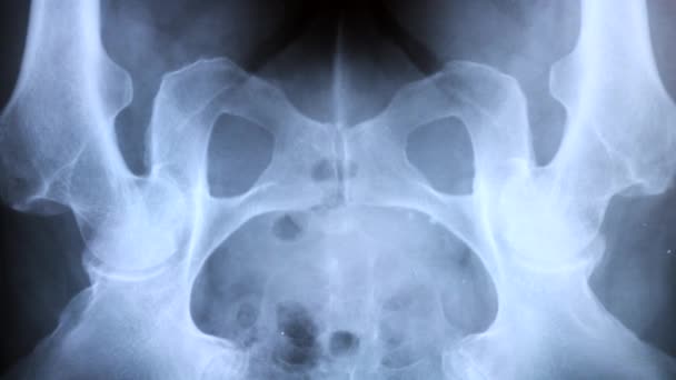 骨盤骨のX線を研究する医師 — ストック動画