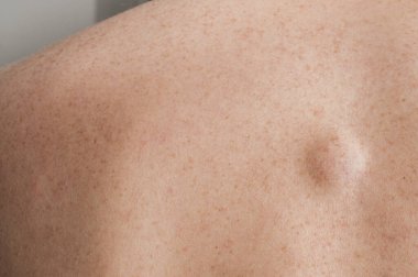 Small lipoma on the back of caucasian man clipart