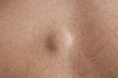 Lipoma close up shot on the back of a caucasian man clipart
