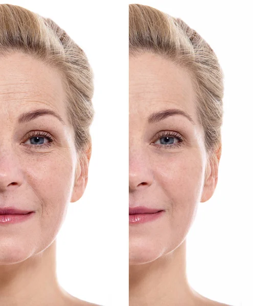 Μέσης ηλικίας γυναίκα, πρόσωπο, πριν και μετά τη διαδικασία καλλυντικά. Έννοια της πλαστικής χειρουργικής. — Φωτογραφία Αρχείου