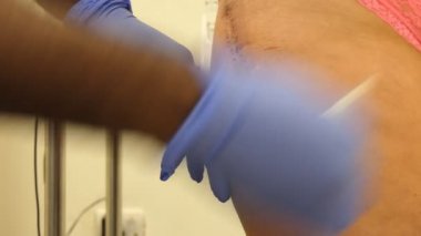 Siyah erkek hemşire elleri iyileşmiş yara kalça protezi ameliyatı veya işlemi sonra kaldırırken metal zımba veya klipleri kadar yakın