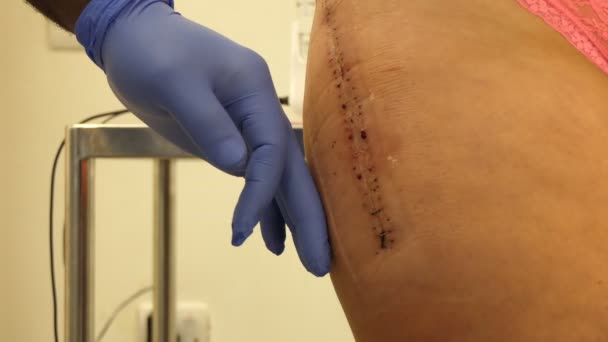人工股関節置換術または操作後治癒の傷から金属ステープルやクリップを削除するときに黒のオスの看護婦の手クローズ アップ — ストック動画