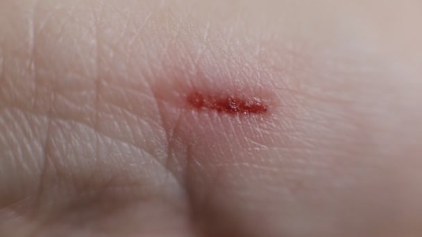 Tiefe Wunde, Kratzer am Finger, Hintergrund, Makro, Blut — Stockvideo