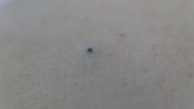 İnsan derisinde siyah sivilce, arka planda. Sivilce ve akne tedavisi, kozmetoloji