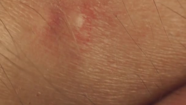 Macro of pustule acne. Fingers touch skin next to the pimple zit on hand. Body parts of white male caucasian. Dermatology and skincare. Allergic response to bad cosmetics and poor nutrition — Stock Video