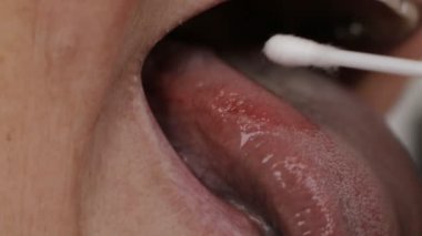 Bir kadının dilindeki hastalık için leke sürüyor. Glossitis ve diş eti iltihabı dil hastalığı araştırma konsepti, tıbbi