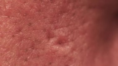 Tımarlanmamış diyabet derisi ve kirlenmiş gözenekleri olan bir burun makrosu. Beyaz, beyaz, beyaz bir erkeğin vücut parçaları. Dermatoloji ve cilt bakımı. Kötü kozmetiklere karşı alerjik tepki ve yetersiz beslenme