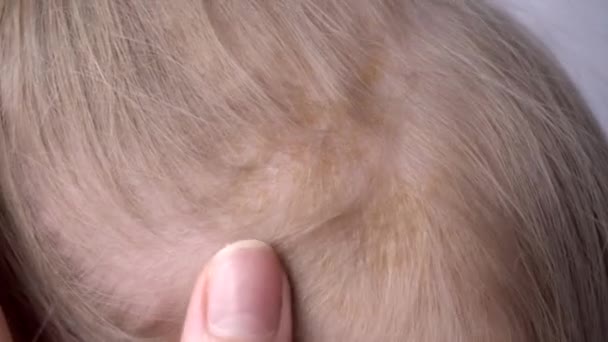 Seborrhoischer Hautausschlag am Kopf des Kindes, seborrhoische Dermatitis, Nahaufnahme, Gesundheitswesen, Medizin — Stockvideo