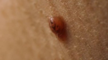 Bir insanın boynundaki ben nevusu, makro. Deride papilloma, dermatoloji.