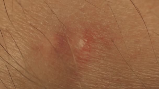 Gros bouton rouge furoncle sur la peau d'une personne, plan macro. Inflammation d'acné, abcès — Video