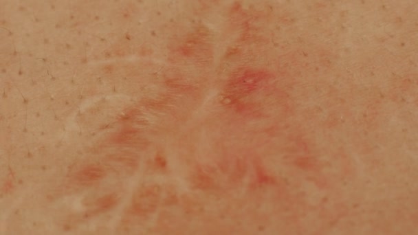 A scar on a person s skin, macro. Scar healing agents, background, medical — Stock Video