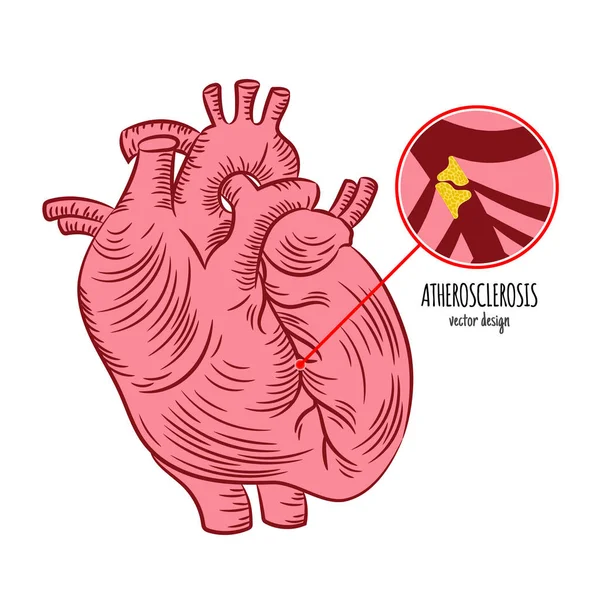 Aterosclerose Medicina Crônica Doença Diagrama Educação Esquema Vetor Humano Desenho — Vetor de Stock