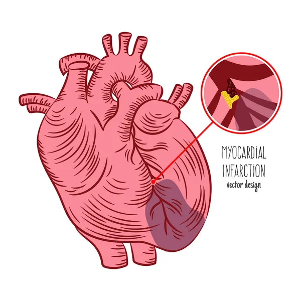 Myocardial Infarction Scheme Heart Attack Medicine Education Diagram Vector Scheme — 스톡 벡터