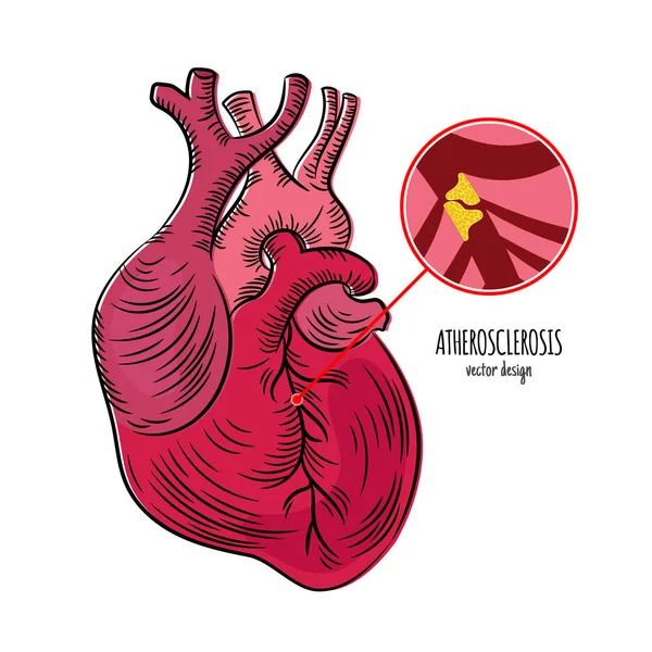 Atherosclerosis Disease Chronic Illness Medicine Education Diagram Vector Scheme Human - Stok Vektor