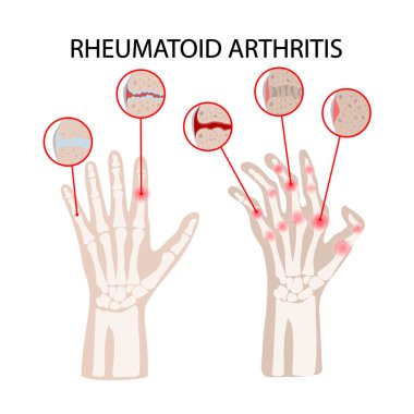 Romatoid Artrit Hastalığı Kronik Hastalık Tıp Eğitimi Diyagram Vektör Şeması İnsan eli Çizim Vektörü İllüstrasyonu