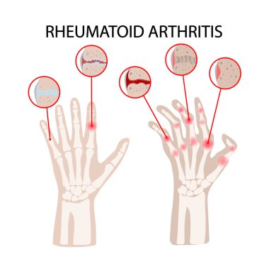 RHEUMATOID ARTHRITIS DISEASE Chronic Illness Medicine Education Diagram Vector Scheme Human Hand Draw Vector Illustration clipart