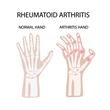 Romatoid Artrit Beyaz Kronik Hastalık Tıp Eğitimi Diyagram Vektör Şeması İnsan eli Çizim Vektörü İllüstrasyonu