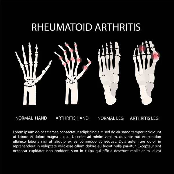 Artritida Ruční Noha Revmatoidní Chronická Onemocnění Medicína Vzdělávání Diagram Vektorové — Stockový vektor