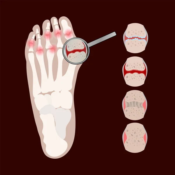 Arthritis Leg Rheumatoid Chronic Disease Medicine Education Diagram Vector Scheme - Stok Vektor