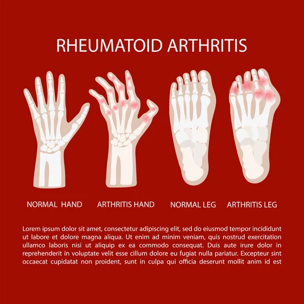 Arthritis Láb Kéz Reumatoid Krónikus Betegség Orvostudomány Oktatás Diagram Vektor — Stock Vector