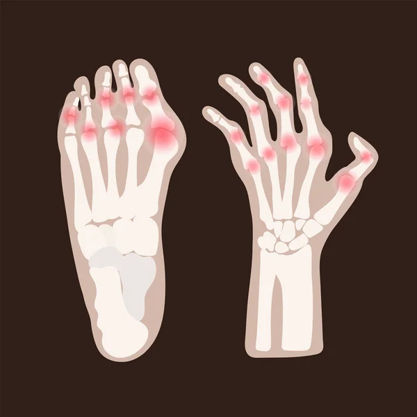 Χέρι Πόδι Αρθρίτιδα Ρευματοειδής Χρόνια Ασθένεια Ιατρική Εκπαίδευση Διάγραμμα Σχήμα — Διανυσματικό Αρχείο