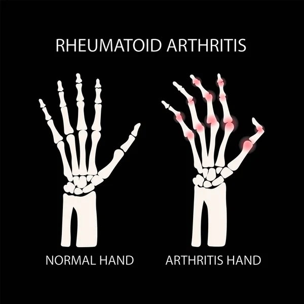 Revmatoidní Artritida Černá Chronická Nemoc Medicína Vzdělávací Diagram Vektorové Schéma — Stockový vektor