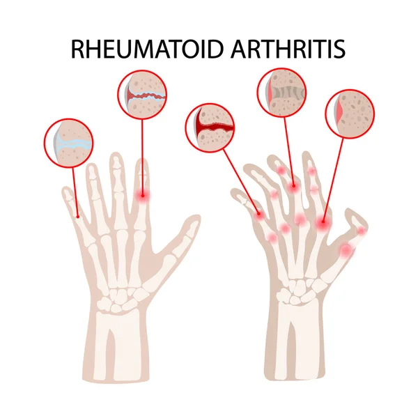 Enfermedad Artritis Reumatoide Enfermedad Crónica Esquema Vectorial Diagrama Educación Dibujo — Vector de stock