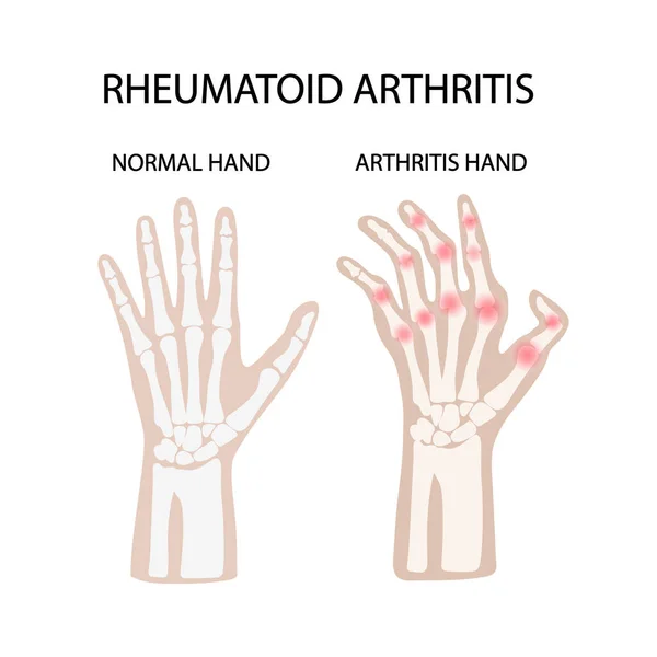 Rheumatoid Arthritis Fehér Krónikus Betegség Orvostudomány Oktatás Diagram Vektor Rendszer — Stock Vector
