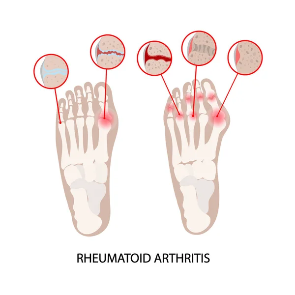 Maladie Rheumatoide Leg Arthrite Maladie Chronique Médecine Diagramme Éducatif Schéma — Image vectorielle