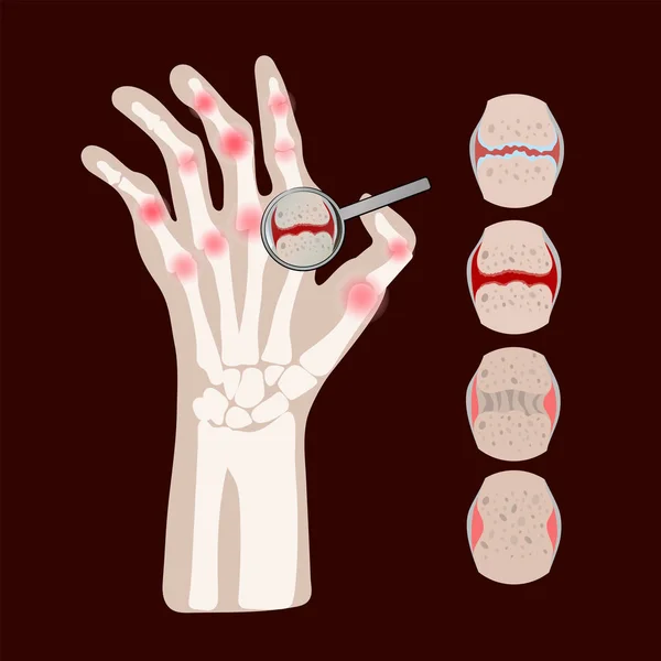 Rheumatoid Disease Arthritis Chronic Illness Medicine Education Diagram Vector Scheme - Stok Vektor