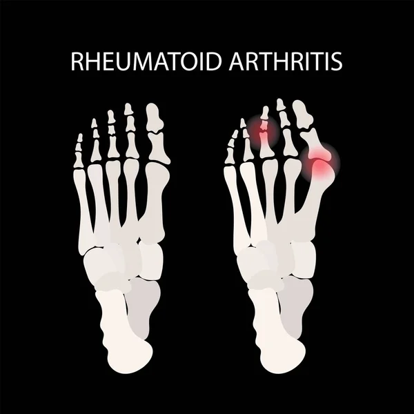 Rheumatoid Arthritis Láb Krónikus Betegség Orvostudomány Oktatás Diagram Vektor Rendszer — Stock Vector