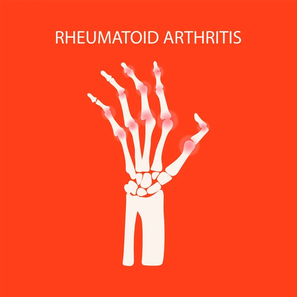 레트로 Hand Rheumatoid Disease Chronic Disease Education Diagram Vector Scheme — 스톡 벡터