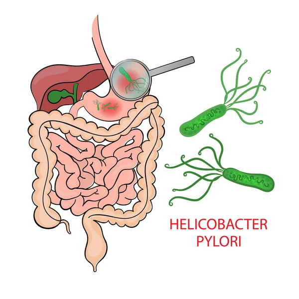 Helicobacter Pylori Medicine Education Diagramma Schema Vettoriale Illustrazione Del Vettore — Vettoriale Stock