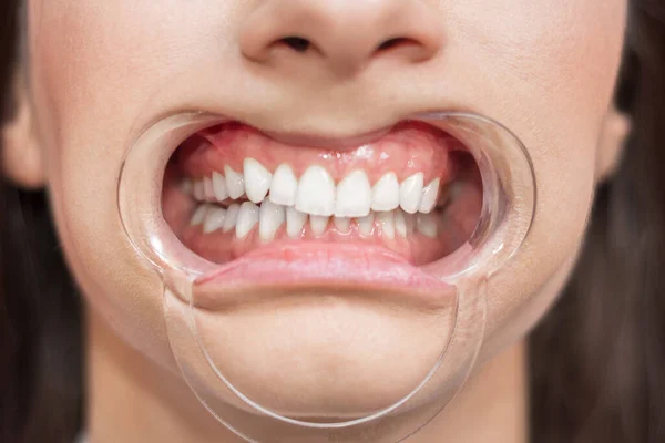 Pemutih Gigi Gadis Dengan Mulut Terbuka Dan Corong Dokter Gigi — Stok Foto